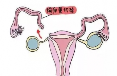 河南慈铭博鳌国际医院三代试管婴儿，切除双侧输卵管还能做试管婴儿吗？